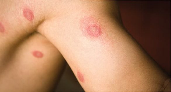 Skin disease Skin disease